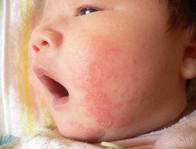 新生儿为什么会得湿疹如何处理,小儿湿疹的原因及治疗方法
